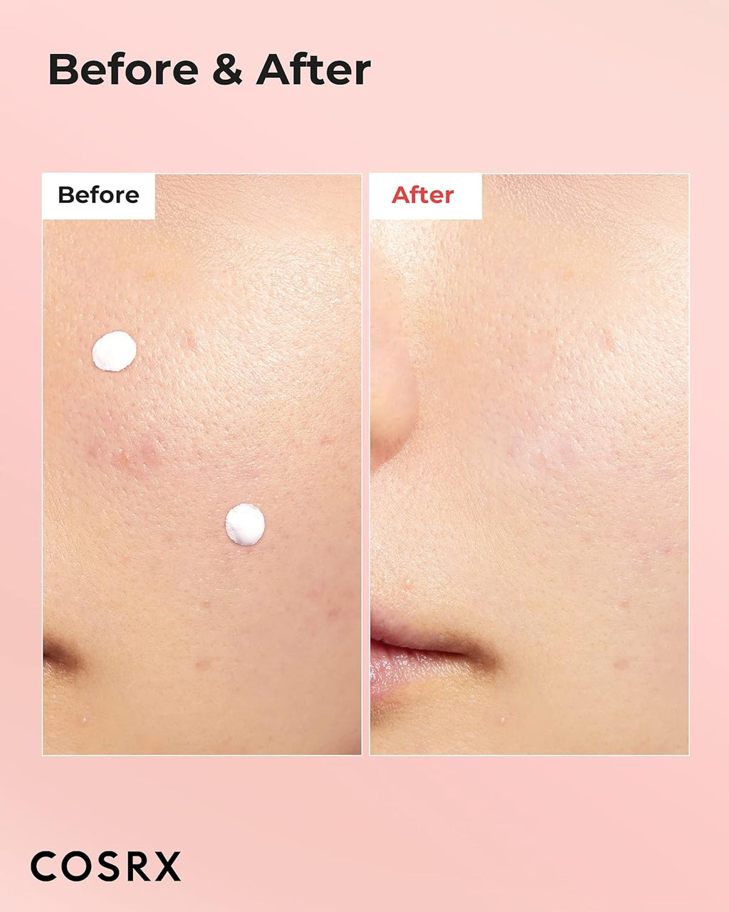 COSRX Acne Blemish Spot Drying Lotion 1.01 fl. oz / 30ml Dry and Reduce Blemish Spot, Pimple, Whitehead, Spot Treatment, Korean Skin Care
